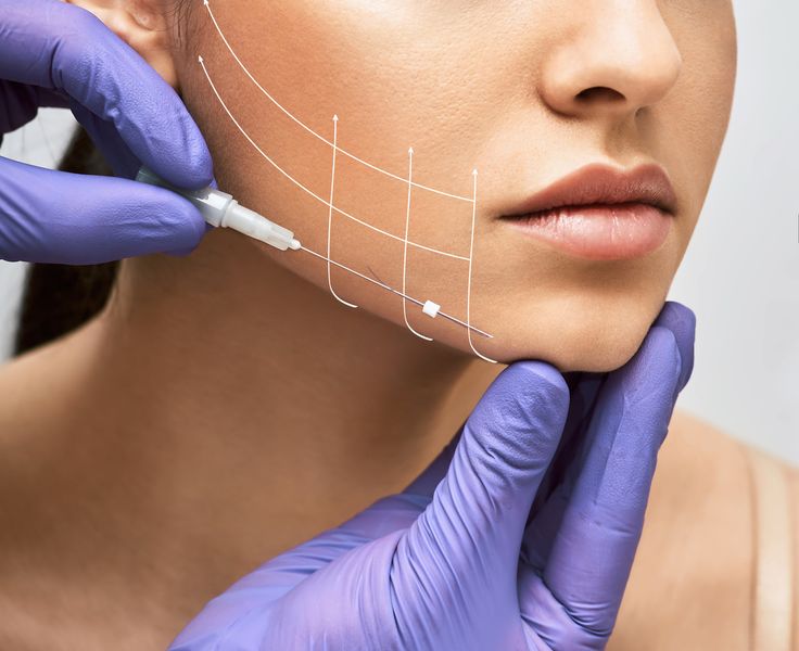 Reality Check: The Truth About Thread Lift Longevity and Safety